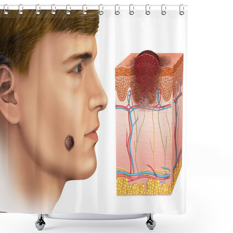 Personality  Melanoma In The Face Shower Curtains