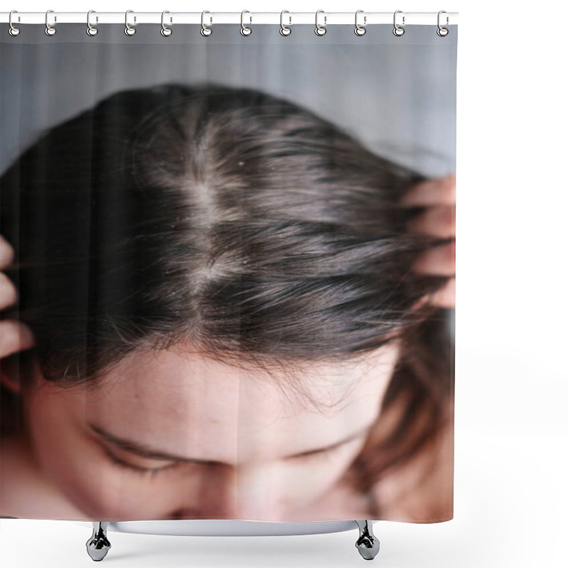 Personality  Dandruff On The Girls Head, Diseases Of The Scalp Shower Curtains