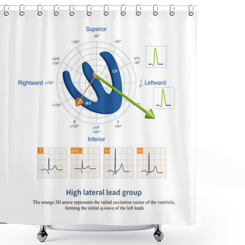 Personality  The High Lateral  Lead Group Includes Leads I And AVL, Used To Explore The Myocardium Of The High Lateralwall Of The Left Ventricle. Shower Curtains