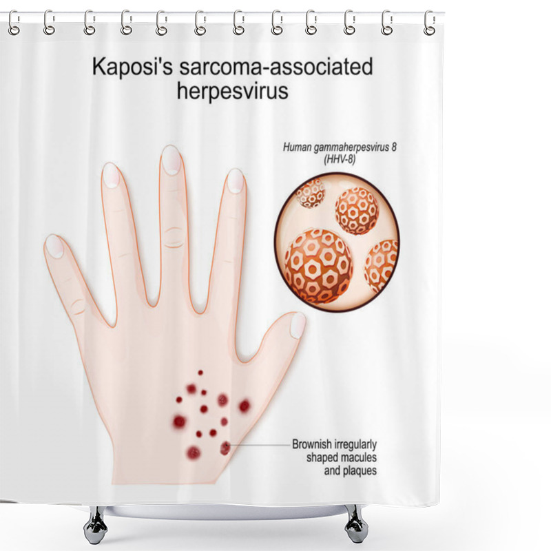 Personality  Kaposi's Sarcoma-associated Herpesvirus. Human's Hand With Brownish Irregularly Shaped Macules And Plaques. Close-up Of Human Gammaherpesvirus (HHV-8). Vector Illustration Shower Curtains