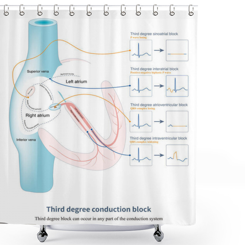 Personality  Third Degree Block Refers To Persistent Or Permanent Interruption Of Conduction, Which Can Occur In Any Part Of The Conduction System And Produce Corresponding Electrocardiogram Changes. Shower Curtains