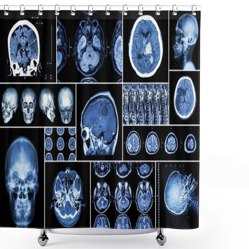 Personality  Set , Collection Of Brain Disease ( Cerebral Infarction , Hemorrhagic Stroke , Brain Tumor , Disc Herniation With Spinal Cord Compression ,etc)( CT Scan , MRI , MRT )( Neurology And Nervous System ) Shower Curtains