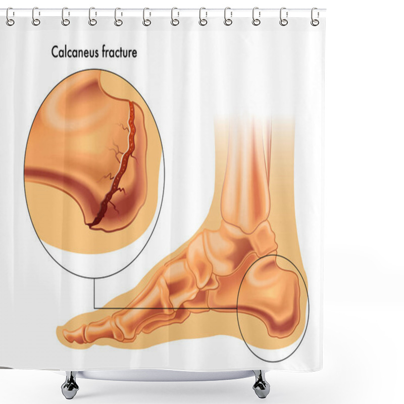 Personality  Calcaneus Fracture Illustration  Shower Curtains