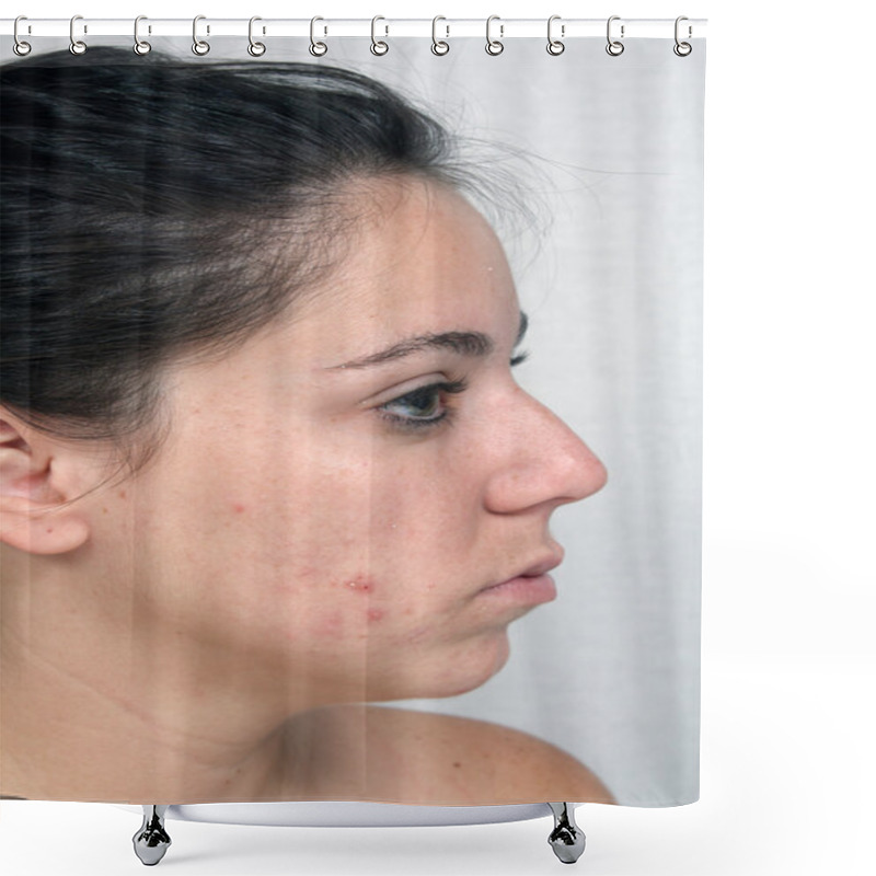 Personality  Girl With Acne (3) Shower Curtains