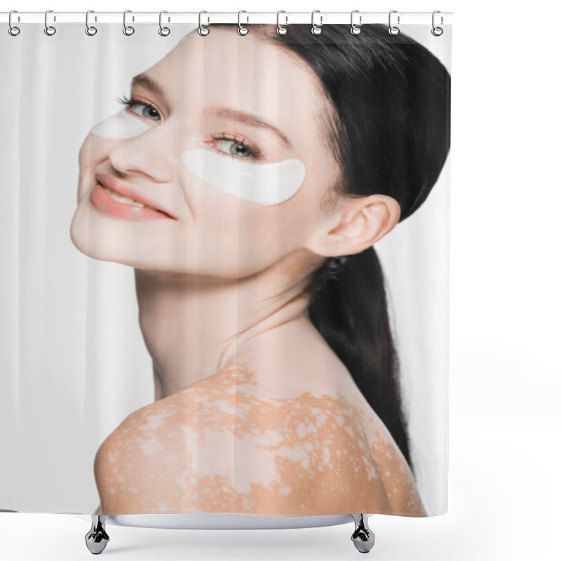 Personality  Smiling Young Beautiful Woman With Vitiligo And Eye Patches On Face Isolated On White Shower Curtains