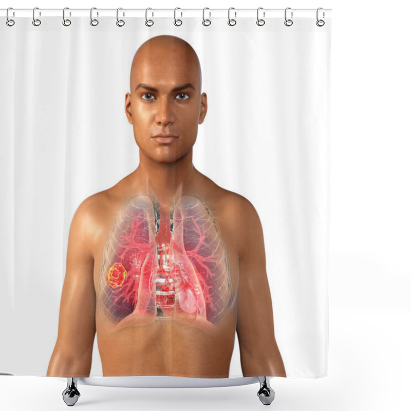 Personality  Lung Mucormycosis, A Lung Disease Caused By Fungi Mucor, Also Known As Black Fungus And Yellow Fungus, 3D Illustration. Covid-19 Complication Shower Curtains