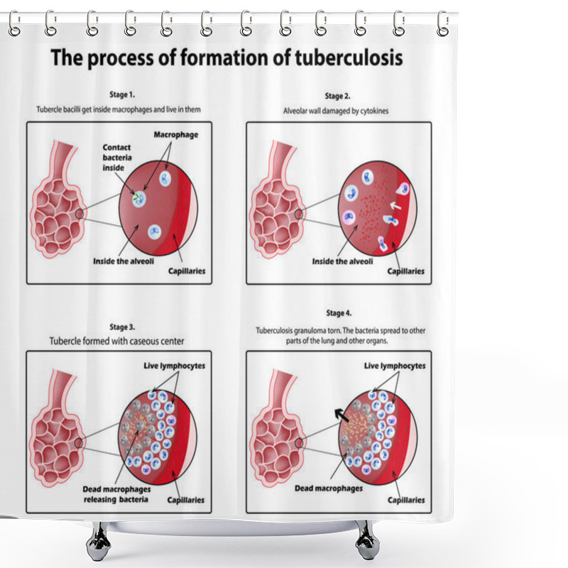 Personality  The Process Of Tuberculosis Formation. Infographics. Vector Illustration On Isolated Background. Shower Curtains