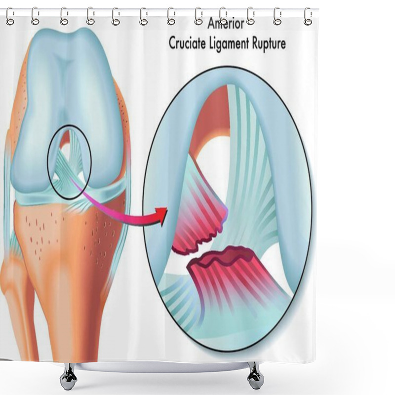 Personality  Medical Illustration Of Anterior Cruciate Ligament Rupture Shower Curtains