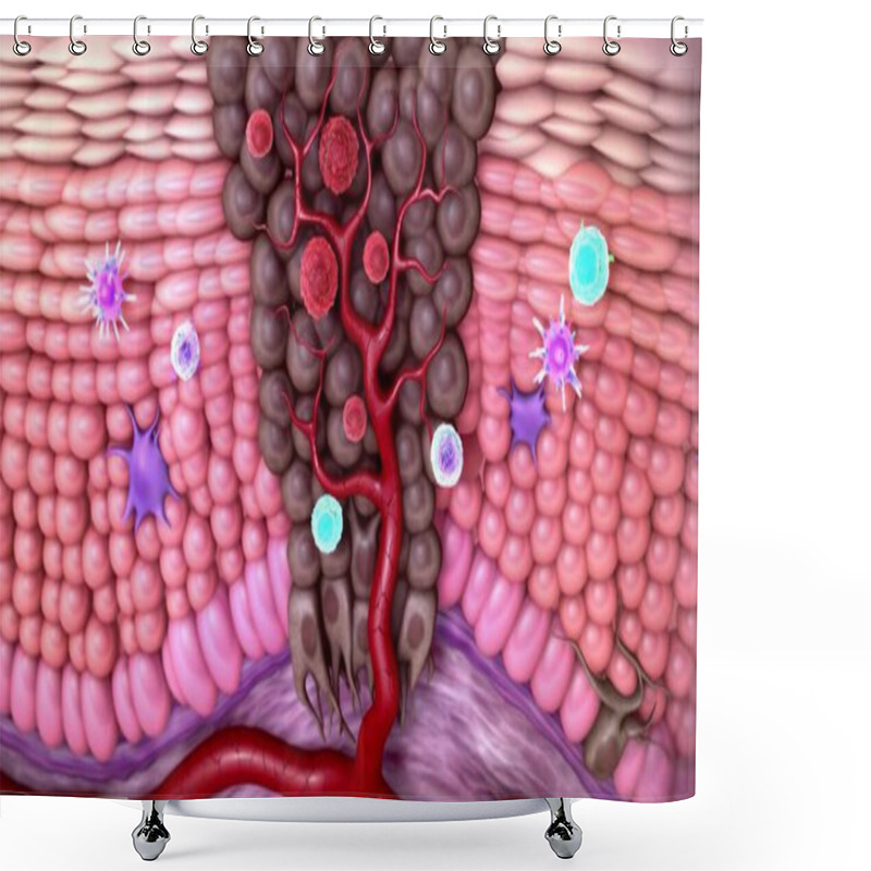 Personality  Melanoma Or Skin Cancer. Layers Of The Human Skin. Shower Curtains