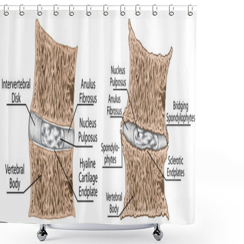 Personality  Coronal Section Through The Third And Fourth Lumbar Vertebrae, Narrowing Of The Intervertebral Disk Space, Sclerosis Of The Vertebral Endplate, Osteophytes, Spondylophytes, Chondrosis, Osteochondrosis, Spondyloarthrosis Shower Curtains