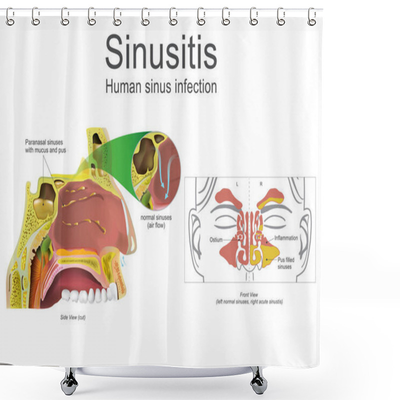 Personality  Human Sinusitis, Inflammation. Illustration, Vector Art. Shower Curtains