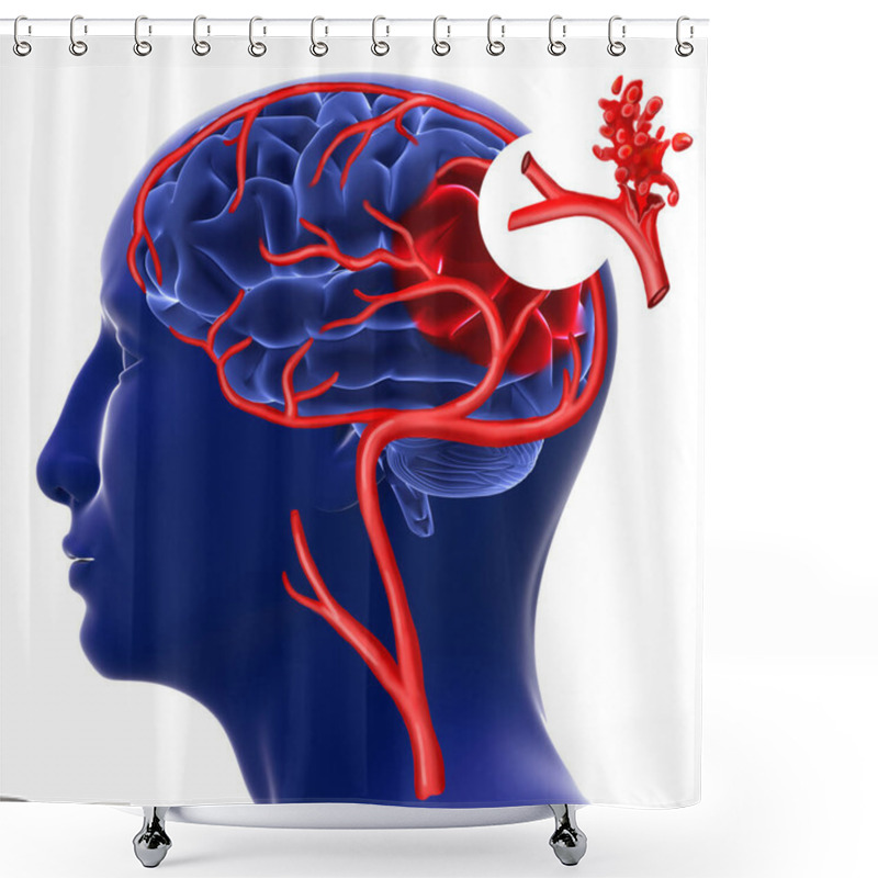 Personality  Brain Hemorrhage. 3d Rendering Shower Curtains