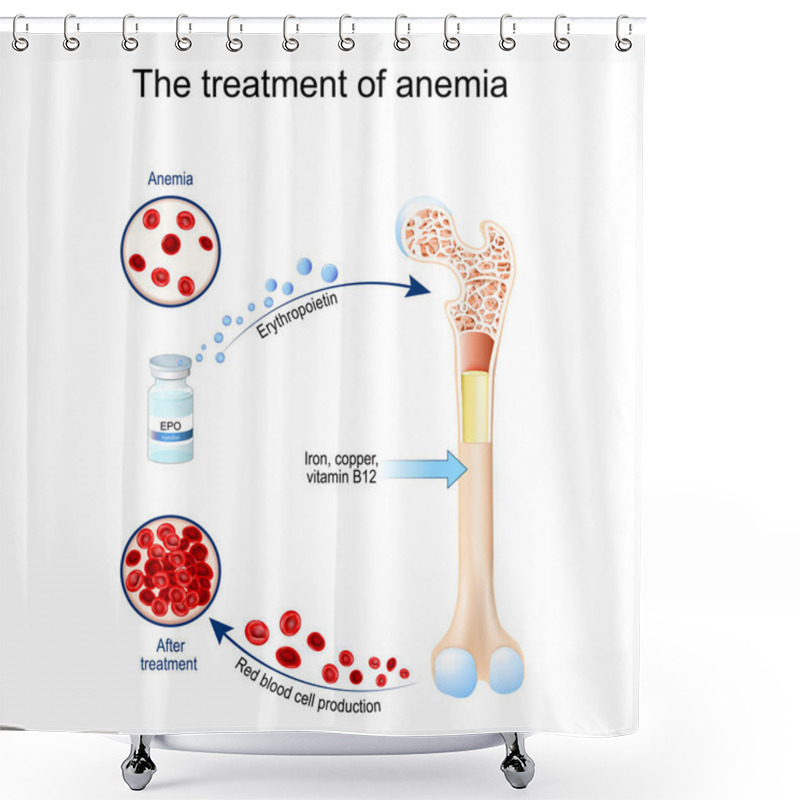 Personality  Erythropoietin And Treatment Of Anemia. Glycoprotein Cytokine That Stimulates Red Blood Cell Production. Erythropoiesis. Vial With EPO. Anemia Before And After Therapy. Vector Illustration Shower Curtains