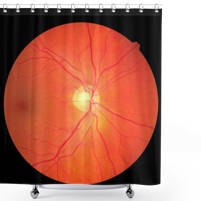 Personality  View Inside Human Eye Disorders Showing Retina, Optic Nerve And Macula. Retinal Picture ,Medical Photo Tractional Eye Screen Retinal Detachment Of Diabetes. Eye Treatment Concept. Shower Curtains