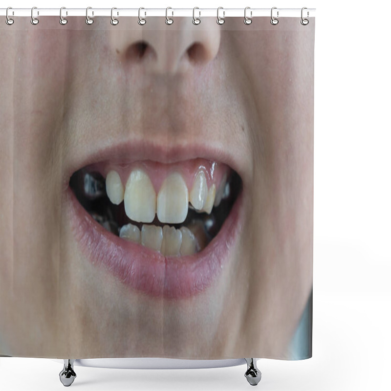 Personality  Orthodontic Problems. A Little Girl With A Shifted Dentition Demonstrates Her Teeth Shower Curtains