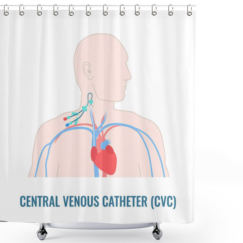 Personality  Internal Jugular Central Venous Catheter Close Up Shower Curtains