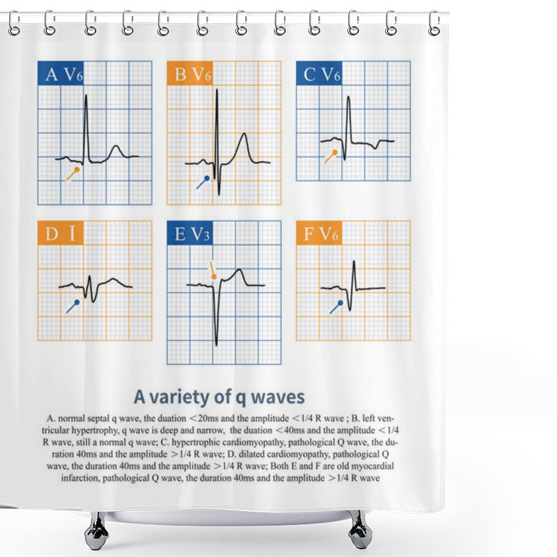 Personality  The Classic Pathological Q Wave Refers To A Q Wave Duration More Than 40ms, With An Amplitude Greater Than 25% R Wave Amplitude, Commonly Seen In Cardiomyopathy And Myocardial Infarction. Shower Curtains