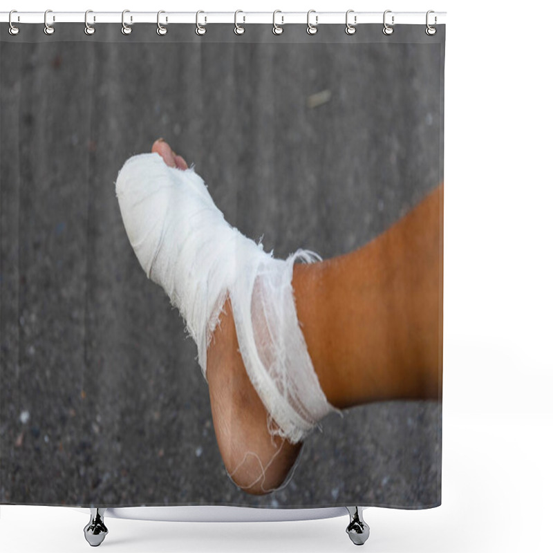 Personality  Male Foot In A Bandage In The Foreground. Damage To The Foot And Fingers, Damage To The Ligaments Of The Lower Limb, Rehabilitation. Medicine And Health. Close-up. Side View. Shower Curtains