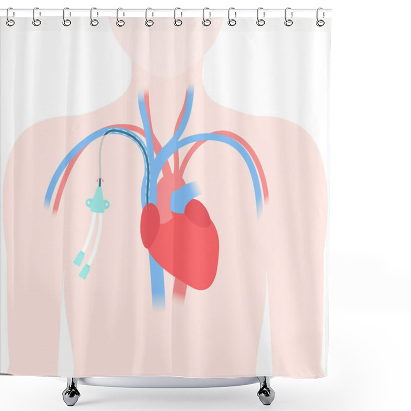 Personality  Tunneled Central Venous Catheter Placed In The Subclavian Vein. Patient With CVC Long Term Access Device For Chemotherapy Infusions And Blood Sampling. Central Line Tube Close Up. Vector Illustration. Shower Curtains