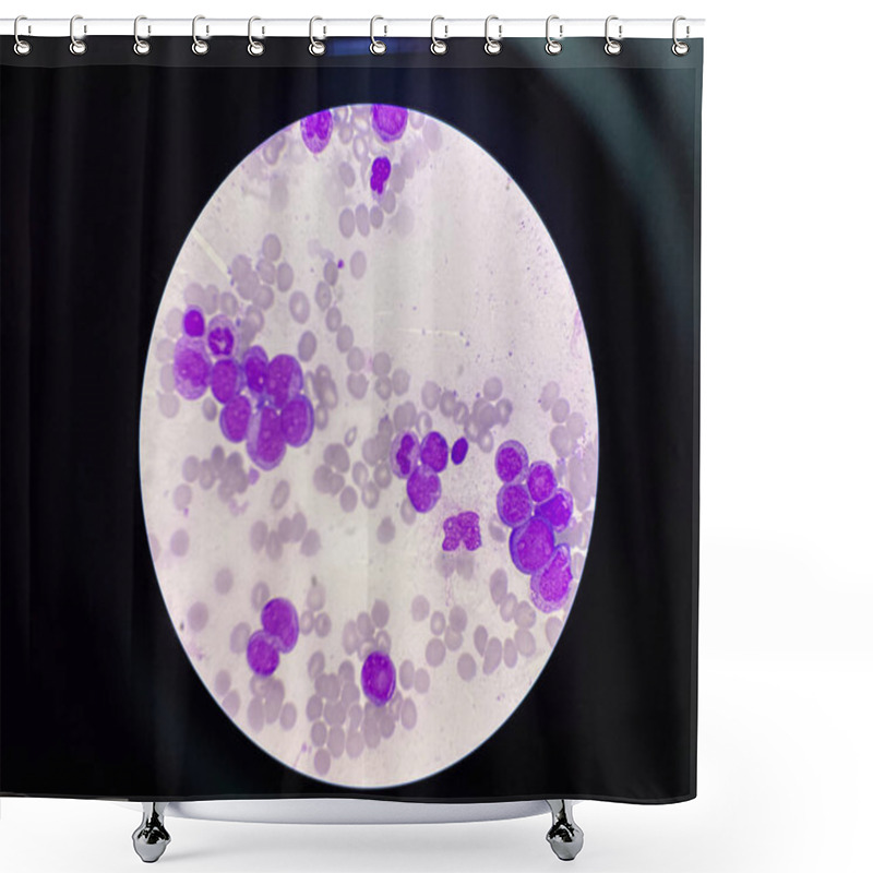 Personality  Immature Leukemic Cell In Leukemia Blood Smear. Shower Curtains