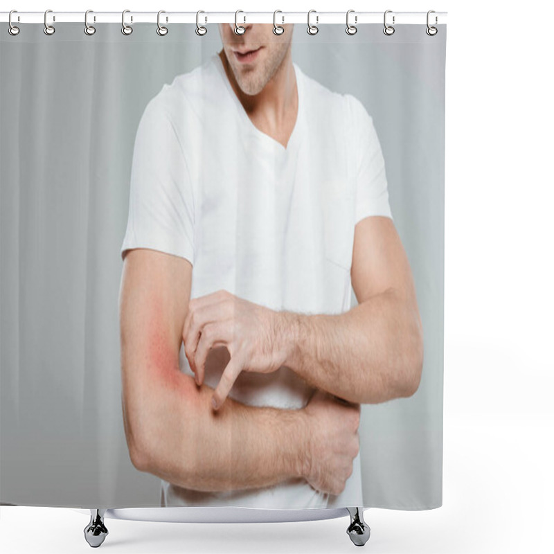 Personality  Cropped View Of Man Scratching Hand With Allergy Isolated On Grey Shower Curtains