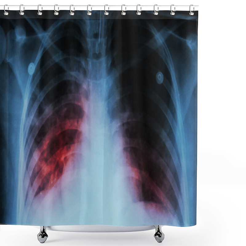 Personality  Pulmonary Tuberculosis ( TB )  :  Chest X-ray Show Alveolar Infiltration At Both Lung Due To Mycobacterium Tuberculosis Infection Shower Curtains