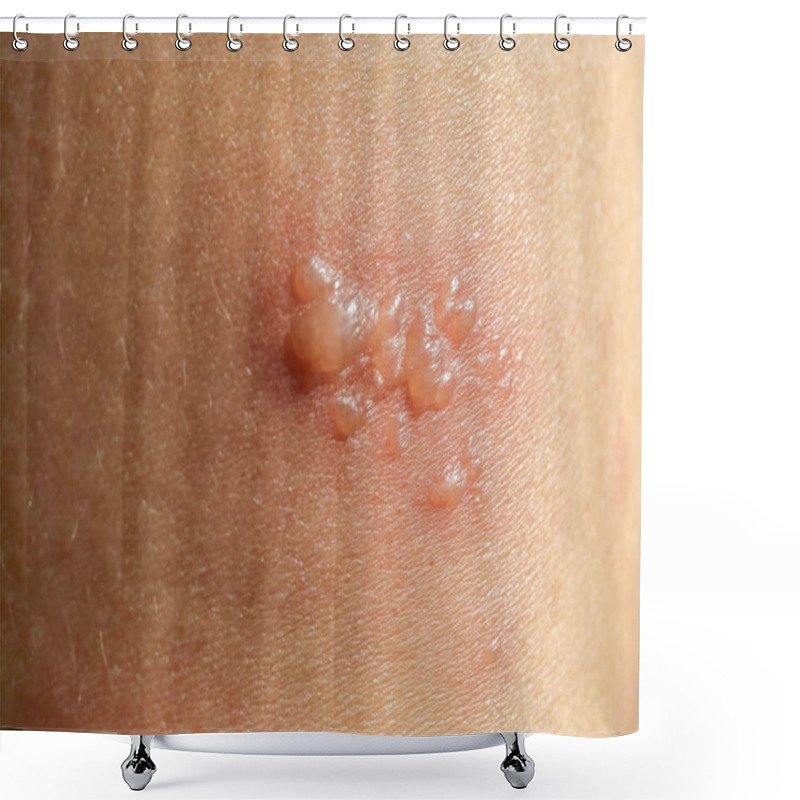 Personality  Skin Rash As Allergic Symptoms Due To Arm Fiberglass Cast Shower Curtains