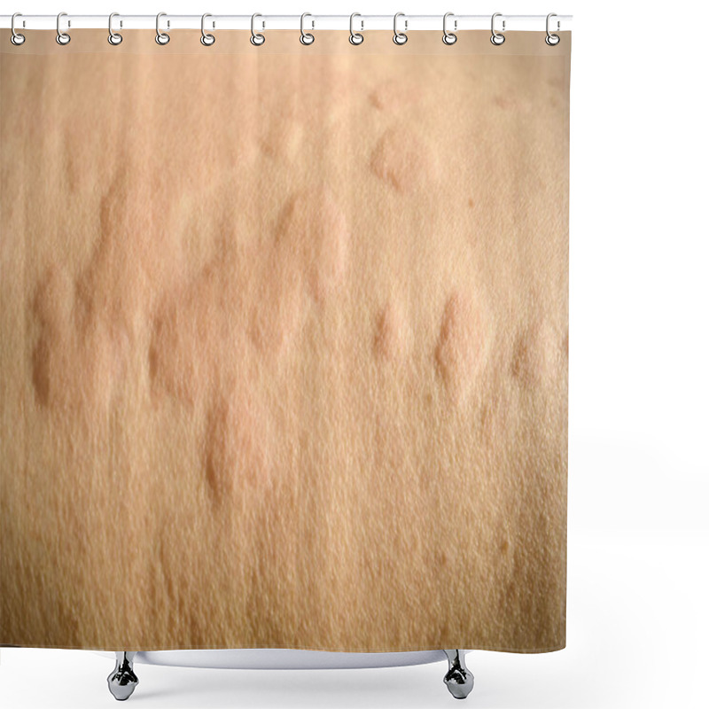 Personality  Skin Rash, Urticaria, Allergic Skin Reaction. Shower Curtains