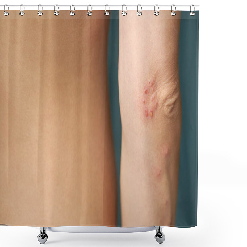 Personality  Insect Bite Marks On A Woman Hand Shower Curtains