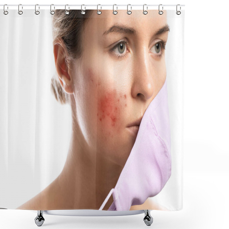 Personality  Young Woman With Prevention Mask And Skin Irritation On White Background. Maskne - Acne Breakouts From Wearing A Face Mask. Shower Curtains