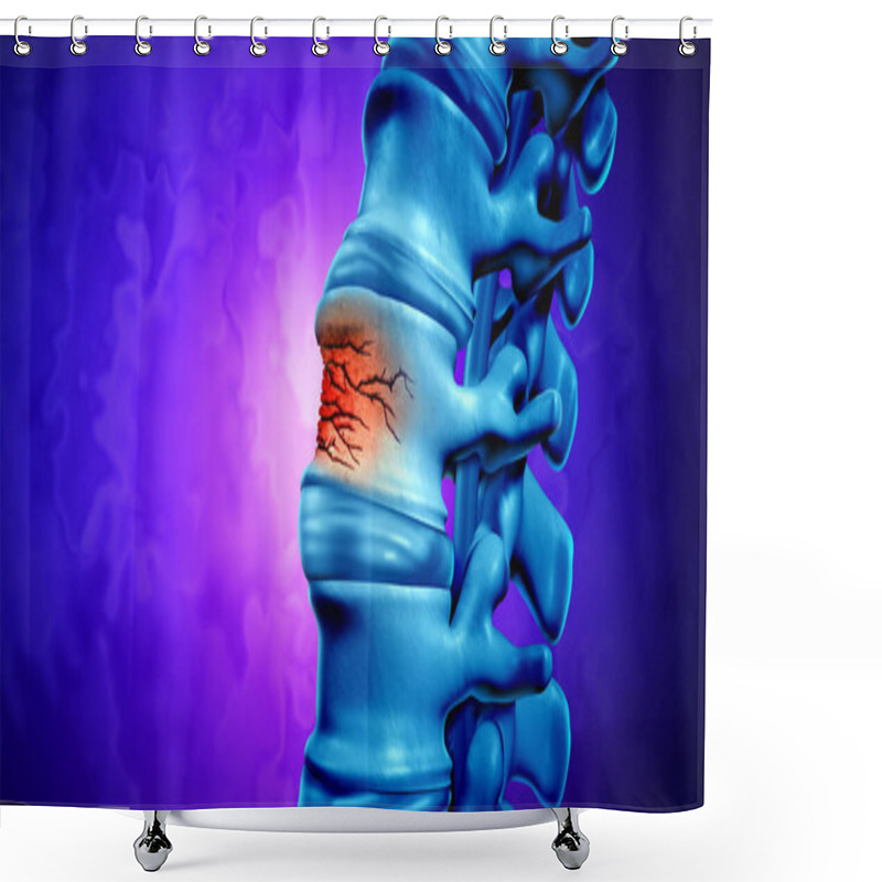 Personality  Traumatic Spine Fracture And Vertebral Injury Medical Concept As A Human Anatomy Spinal Column With A Broken Burst Vertebra Due To Compression Or Other Osteoporosis Back Disease As A 3D Illustration. Shower Curtains