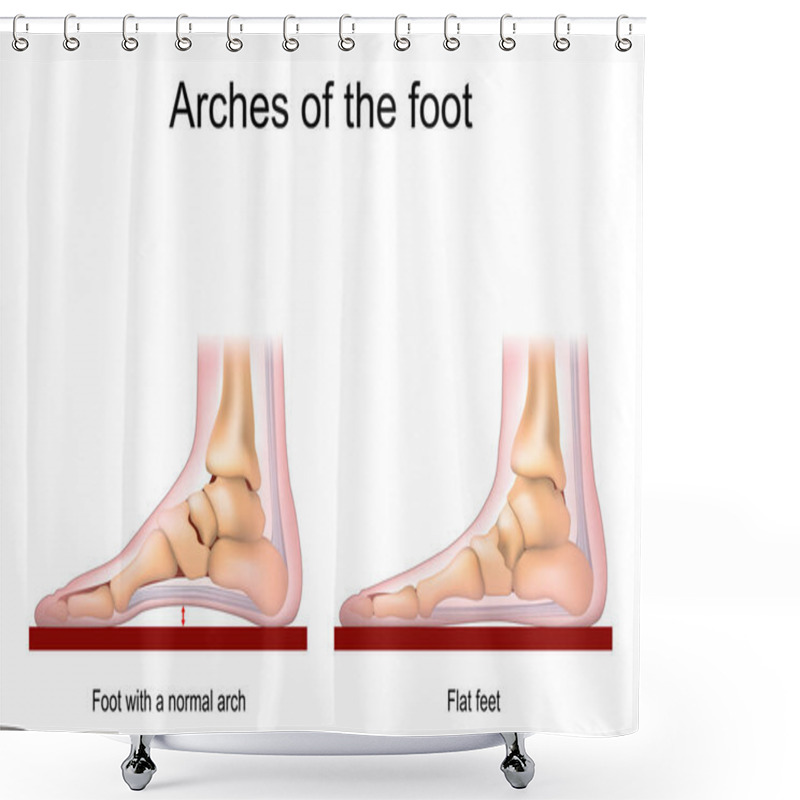 Personality  Arches Of The Foot. Foot With A Normal Arch And Flat Feet. Vector Poster For Medical Use Shower Curtains