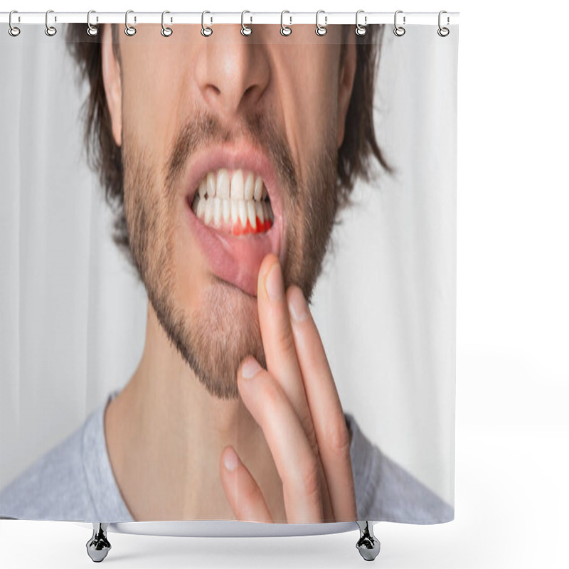 Personality  Man Suffering From Toothache, Tooth Decay Or Sensitivity Shower Curtains