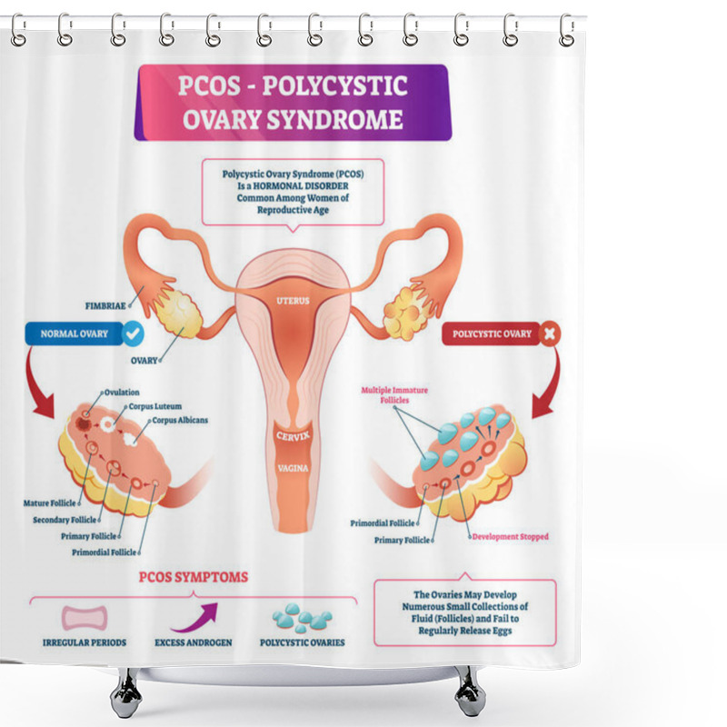 Personality  Polycystic Ovary Syndrome Vector Illustration. Labeled Reproductive Disease Shower Curtains