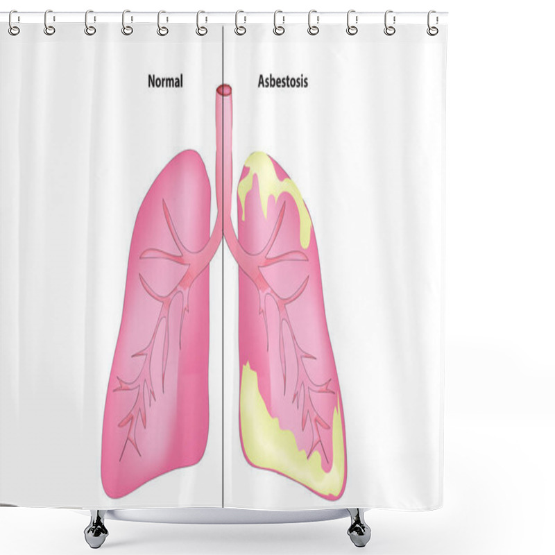 Personality  Asbestosis Anatomy (Diagram Of Asbestosis) Shower Curtains