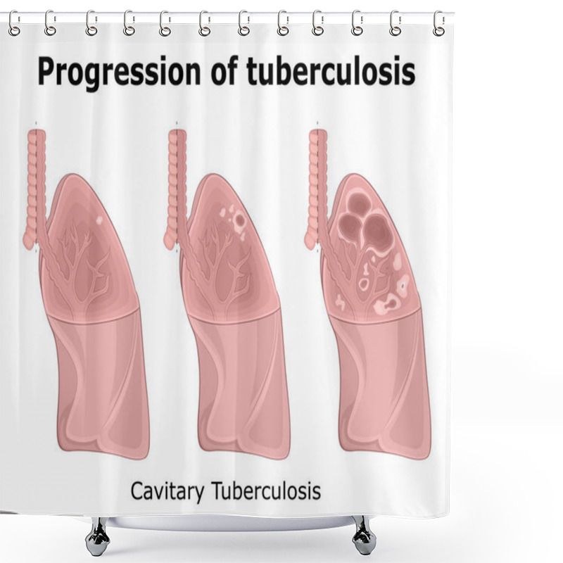 Personality  Illustration Of The Progression Of Cavitary Pulmonary Tuberculosis Shower Curtains