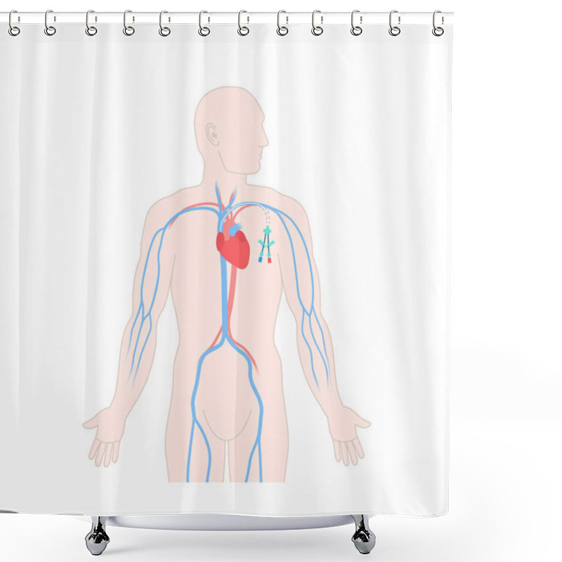 Personality  Tunneled Central Venous Catheter Placed In The Subclavian Vein. Man With CVC Long Term Access Device For Chemotherapy Infusions And Blood Sampling. Central Line Tube. Medical Vector Illustration. Shower Curtains