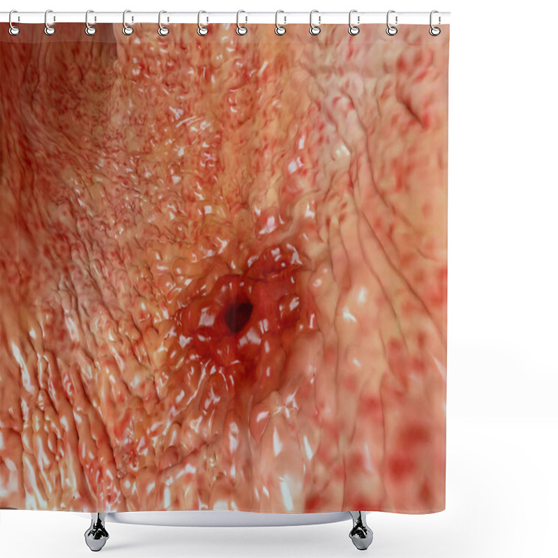 Personality  Human Peptic Ulcer. Illustration Shower Curtains