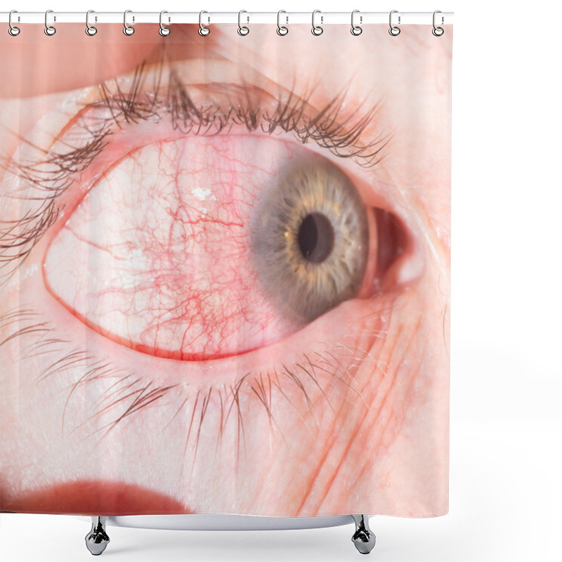 Personality  Episcleritis At Eye Exam Shower Curtains