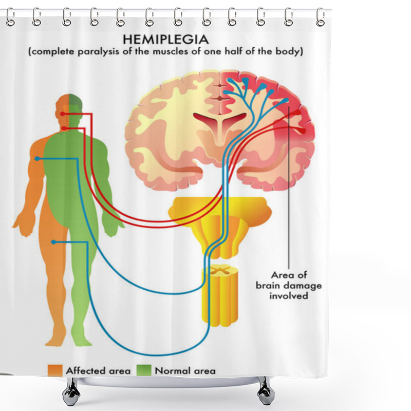 Personality  Hemiplegia, Simply Vector Illustration Shower Curtains