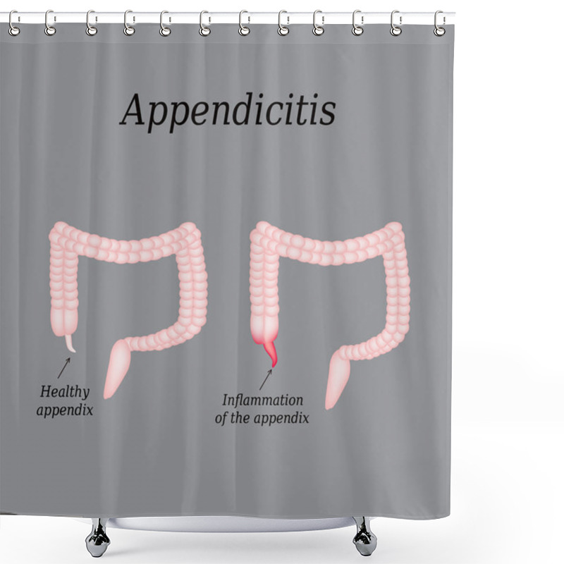 Personality  Appendicitis. Inflammation Of The Appendix. Colon. The Illustration On A Gray Background Shower Curtains