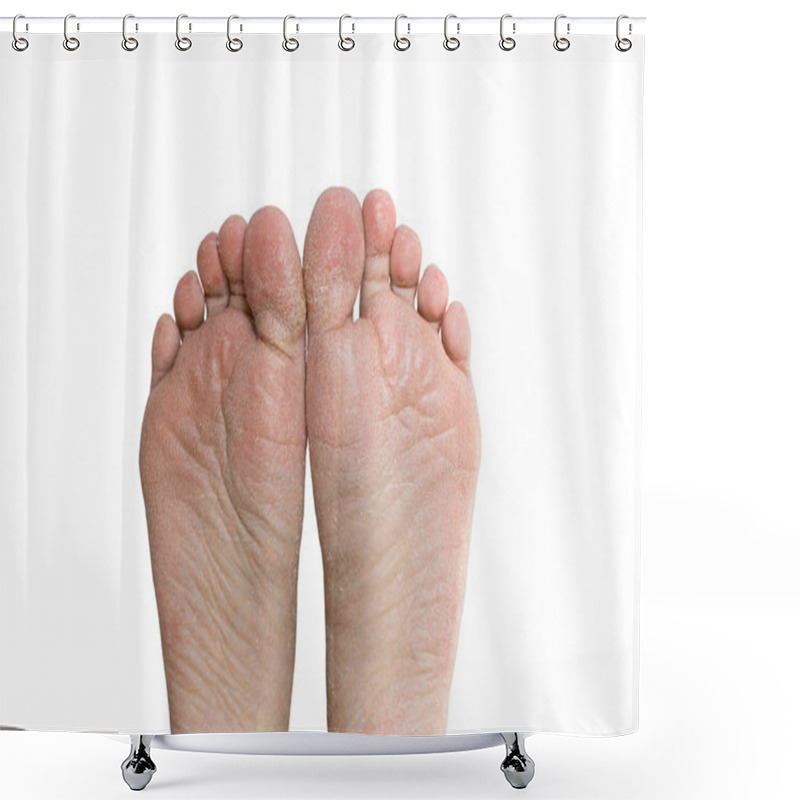 Personality  Close Up Cracked Heels. Health Problems With Skin On Feet Shower Curtains