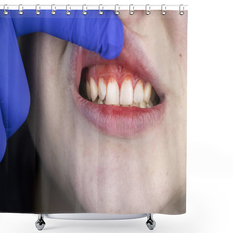 Personality  Gum Bleeding And Inflammation Close Up. A Man Examined By A Dentist. The Diagnosis Of Gingivitis Shower Curtains