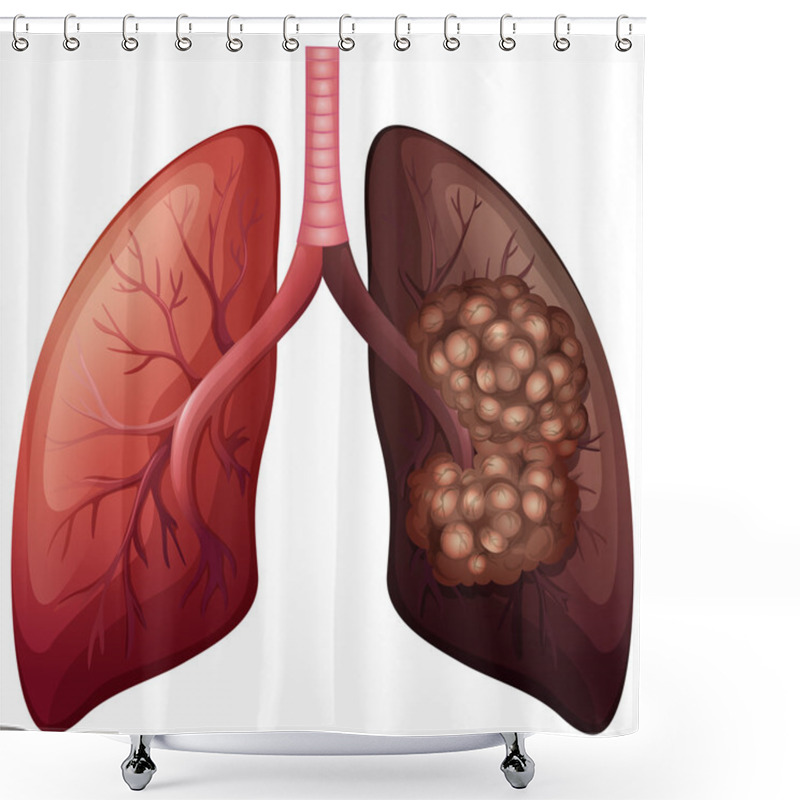 Personality  Normal Lung And Lung Cancer Shower Curtains