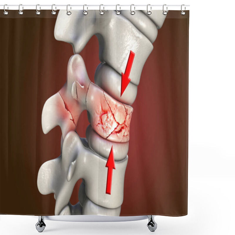 Personality  Spinal Fracture, Traumatic Vertebral Injury, 3D Illustration. Compression Fracture Of The Spine Shower Curtains