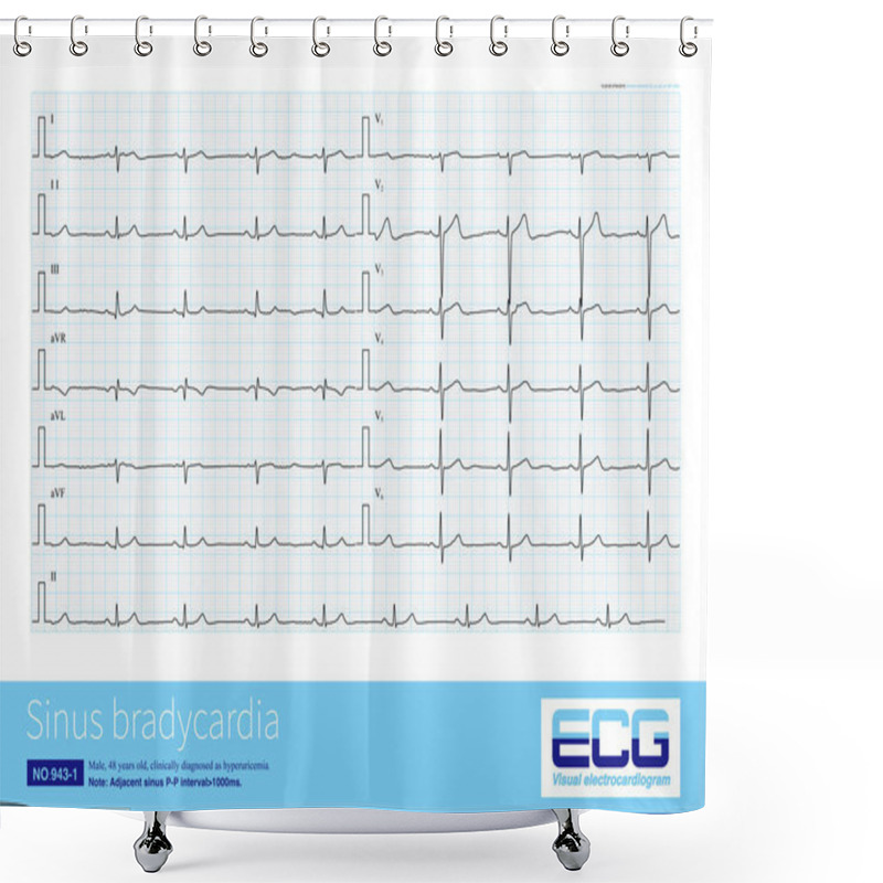 Personality  Generally, When The Sinus Heart Rate Is Below 60 Beats Per Minute, It Is Called Sinus Bradycardia. This Arrhythmia Can Be Both Physiological And Often Pathological. Shower Curtains