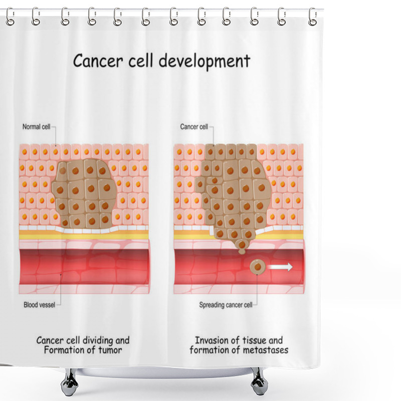 Personality  Cancer Development From Normal Cell To Formation Of Tumor, Spreading Cancer Cells In Blood Flow, Invasion Of Other Tissue, And Formation Of Metastases. Vector Illustration Shower Curtains