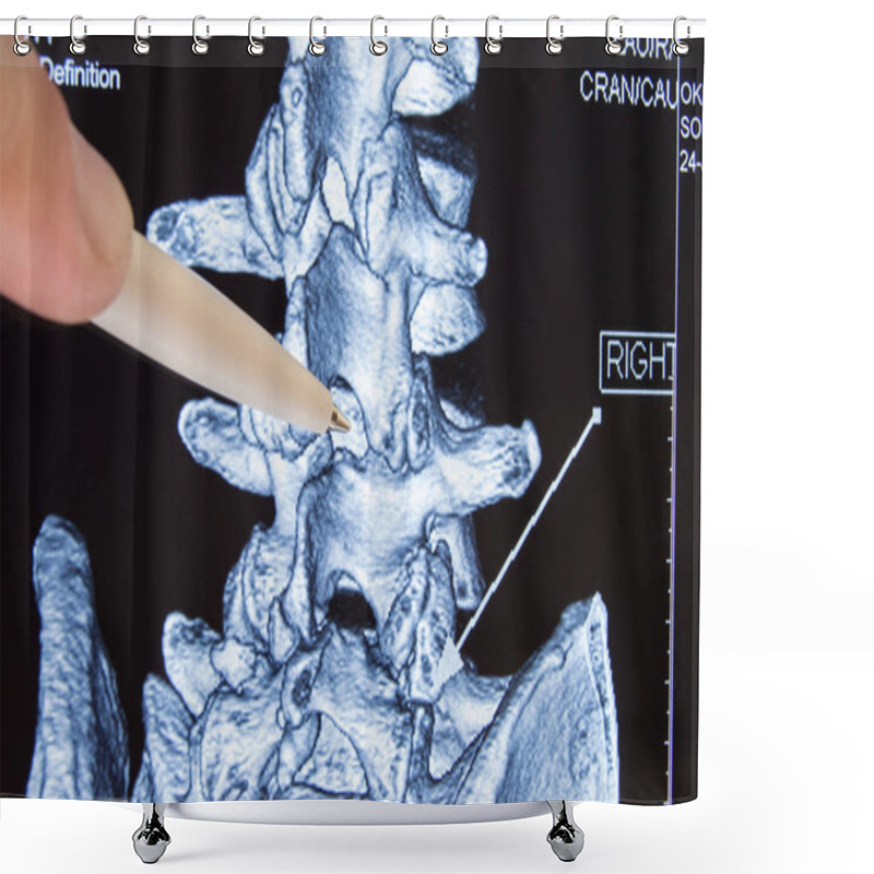 Personality  Doctor Shows On CT MRI Scans Place In Spine Between Vertebrae, Which Is Procedure Of Epidural Anesthesia Or Spinal Puncture Conduct. Epidural Anesthesia During Childbirth Or Neurosurgical Operations  Shower Curtains