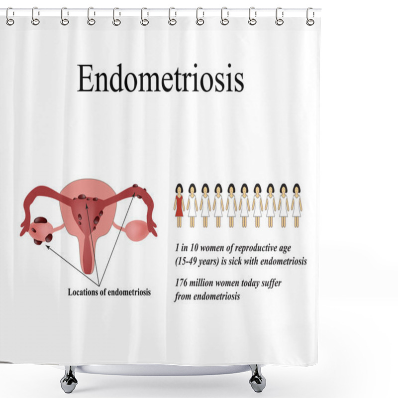 Personality  Endometriosis. Endometrial Cysts. The Endometrium. Statistics Endometriosis. The Structure Of The Pelvic Organs. Infographics. Vector Illustration On Isolated Background Shower Curtains