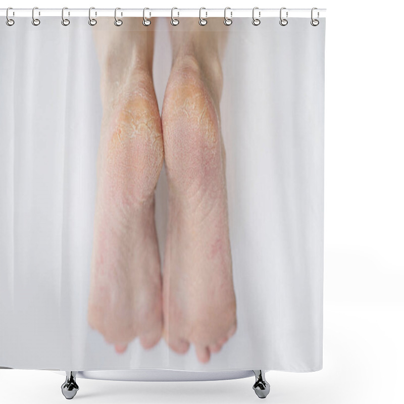 Personality  Close Up Cracked Heels. Health Problems With Skin On Feet Shower Curtains